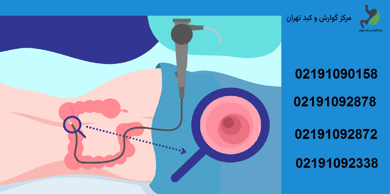 دکتر کولونوسکوپی خانم در تهران