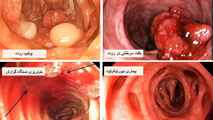 عکس کولونوسکوپی
