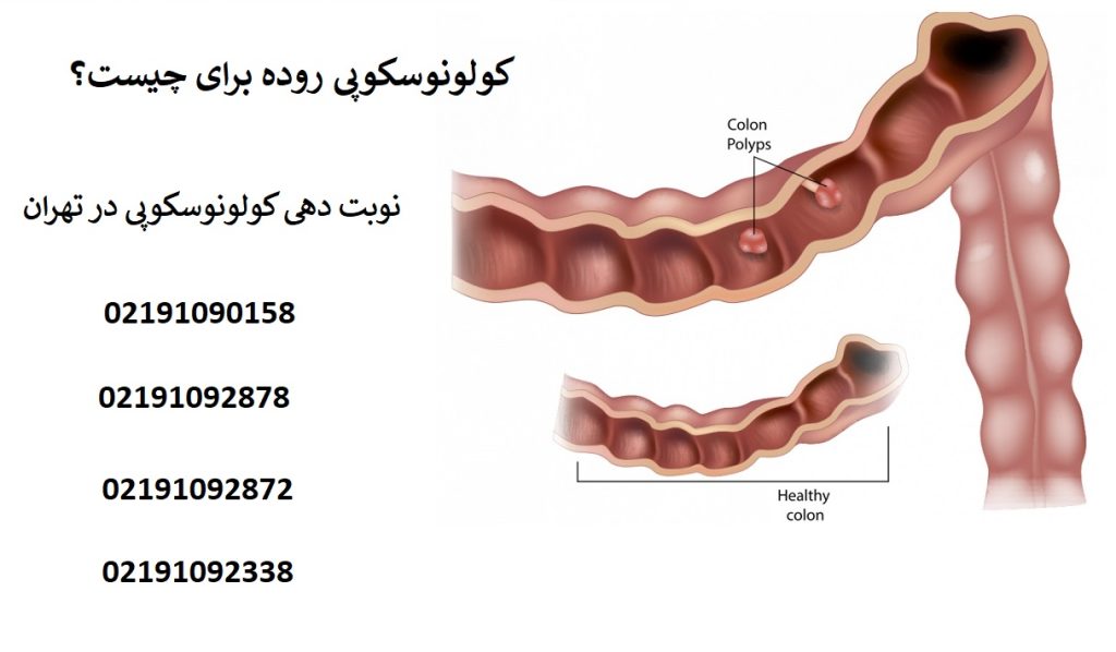 کولونوسکوپی روده برای چیست؟ زمان طلایی برای کولونوسکوپی