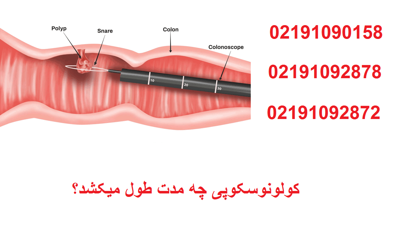 کولونوسکوپی چه مدت طول میکشد؟