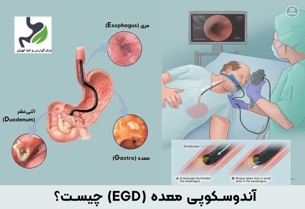 آندوسکوپی طرف قرارداد بیمه ایران | هزینه ها و مراکز تحت پوشش