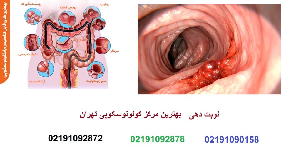 ایا کولونوسکوپی درد دارد؟ ایا کولونوسکوپی نیاز به بیهوشی دارد