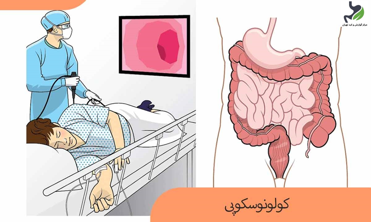 کولونوسکوپی چیست و چرا انجام می‌شود؟